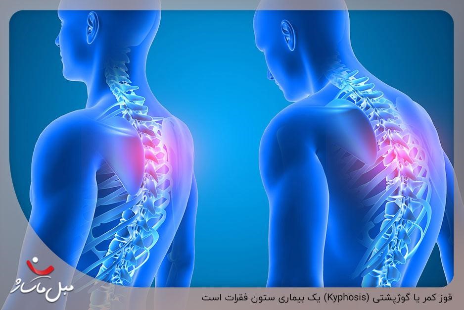 کیفوز ستون فقرات